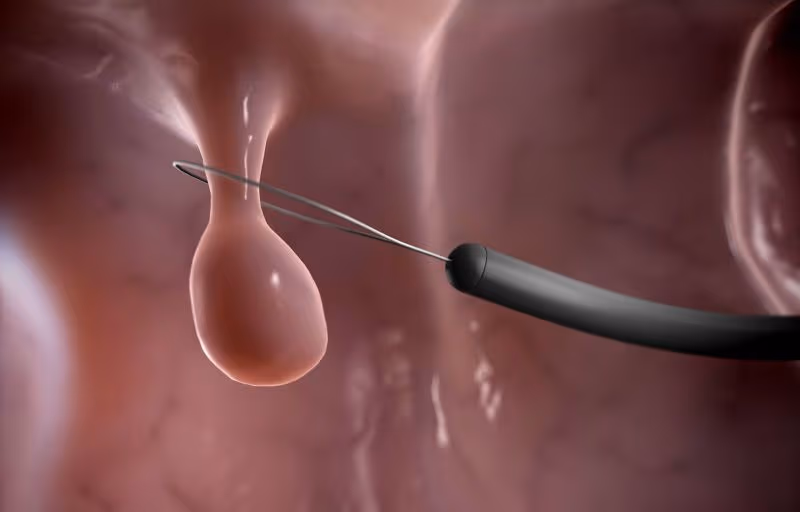 Polyp đại tràng là những khối tăng sinh nhỏ xuất hiện trên bề mặt niêm mạc của đại tràng (ruột già)