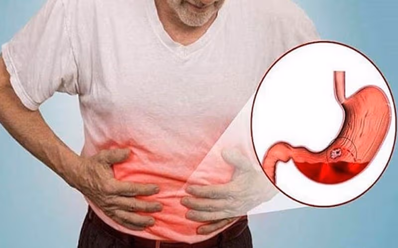 Polyp tá tràng có thể gây chảy máu đường tiêu hóa