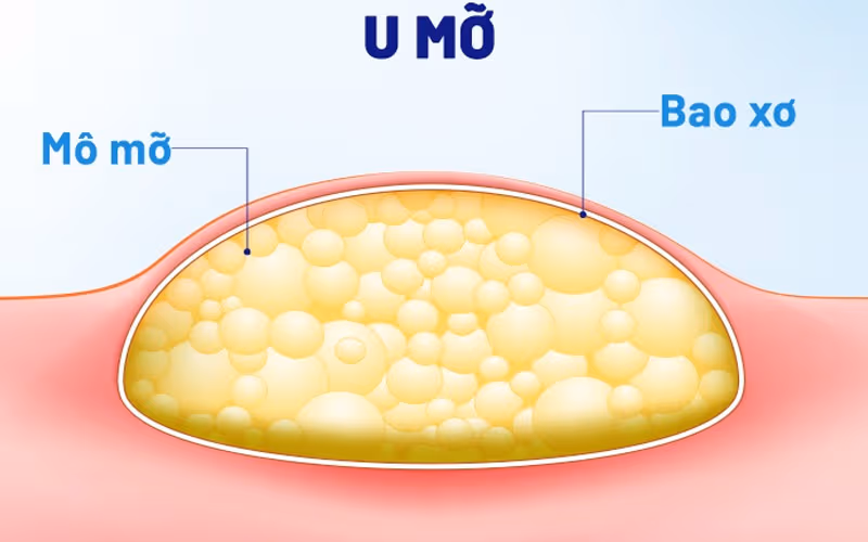 U mỡ là một dạng u thành bụng thường gặp