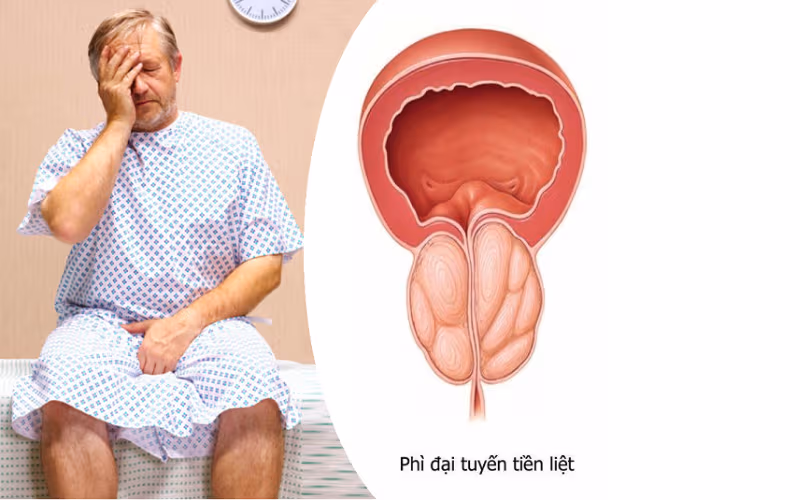 Phì đại tuyến tiền liệt là bệnh gì, nguyên nhân do đâu?