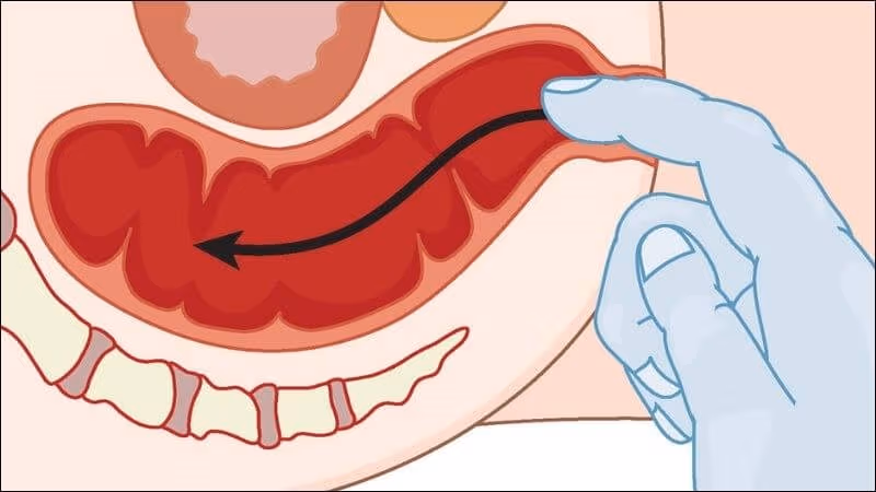 Trĩ kèm sa trực tràng cần được điều trị sớm để tránh biến chứng