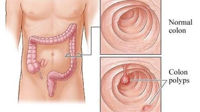 Polyp đại tràng lên có nguy hiểm không? Điều trị và theo dõi như thế nào?
