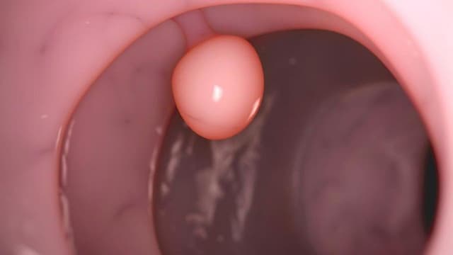 Polyp đại tràng sigma là gì? Dấu hiệu nhận biết và cách điều trị