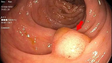 Polyp đại tràng xuống: Nguyên nhân, dấu hiệu, chẩn đoán và điều trị