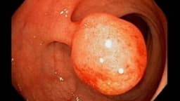 Polyp trực tràng có triệu chứng gì? Điều trị và theo dõi thế nào?
