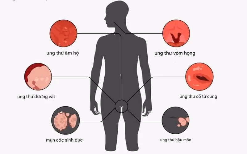 Vắc xin HPV có thể giảm nguy cơ ung thư và một số bệnh do HPV gây ra