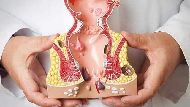 Biến chứng rò hậu môn: Những nguy cơ tiềm ẩn và cách phòng ngừa
