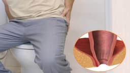 Rò hậu môn xuyên cơ thắt là gì? Dấu hiệu và cách điều trị hiệu quả