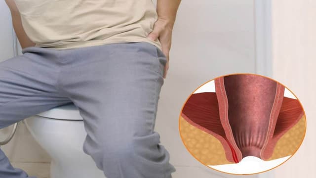 Rò hậu môn xuyên cơ thắt là gì? Dấu hiệu và cách điều trị hiệu quả