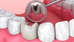 Sâu răng: Điều trị, biến chứng và cách phòng ngừa