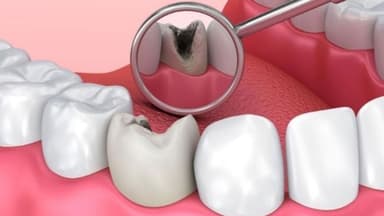 Sâu răng: Điều trị, biến chứng và cách phòng ngừa