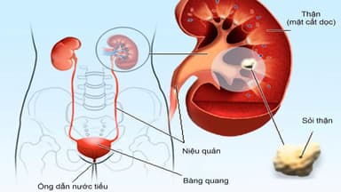 Sỏi đài thận là gì? Dấu hiệu nhận biết và cách điều trị hiệu quả