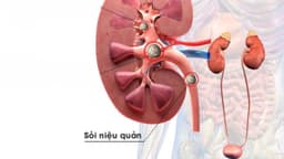 Sỏi niệu quản kèm viêm thận là gì? Có nguy hiểm không?
