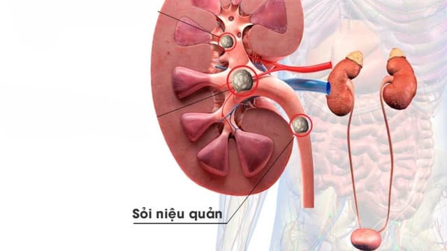 Sỏi niệu quản kèm viêm thận là gì? Có nguy hiểm không?