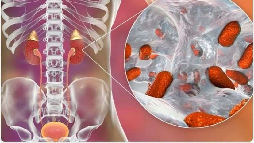 Sỏi thận kèm viêm bể thận: Dấu hiệu cảnh báo và hướng điều trị