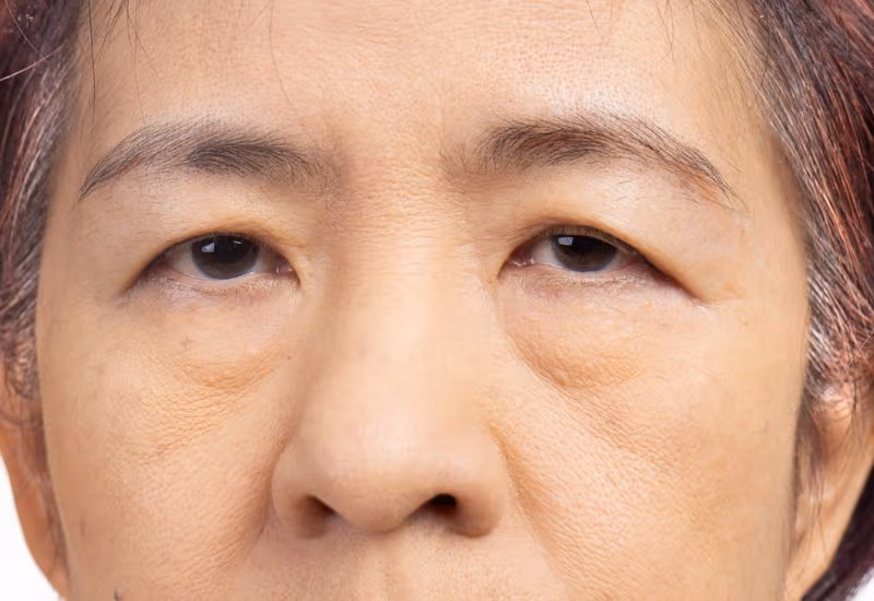 sụp mí mắt