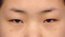 Sụp mí mắt: Nguyên nhân, cách chữa và phẫu thuật