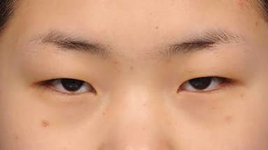 Sụp mí mắt: Nguyên nhân, cách chữa và phẫu thuật