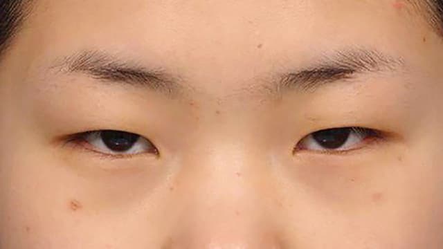 Sụp mí mắt: Nguyên nhân, cách chữa và phẫu thuật