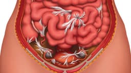 Tình trạng tắc ruột do dính có nguy hiểm không?