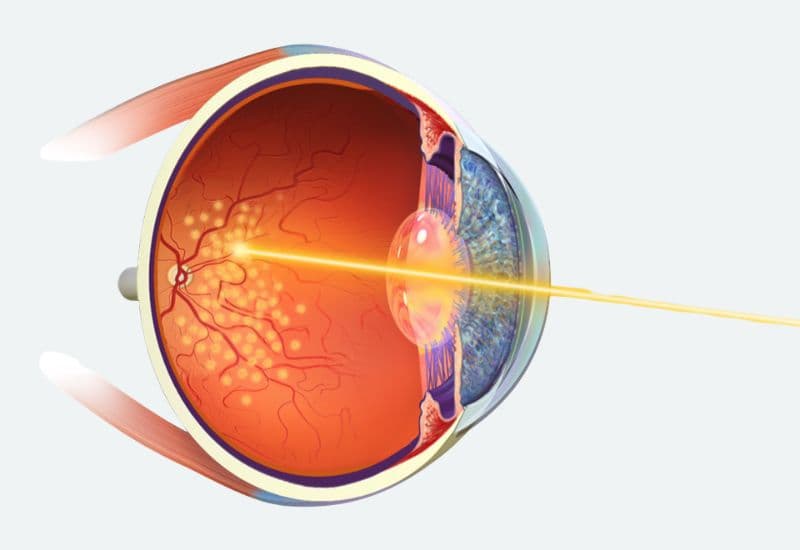 tắc tĩnh mạch võng mạc