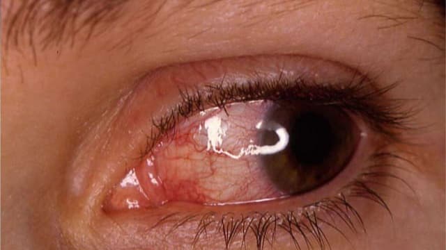 Tắc tĩnh mạch võng mạc: Dấu hiệu, nguyên nhân và điều trị