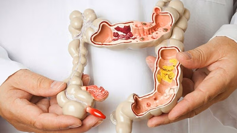 Người từ 45 đến 75 tuổi nên tầm soát ung thư đại tràng định kỳ