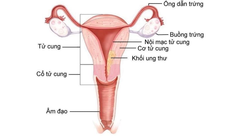 Tăng sản nội mạc tử cung và những điều cần biết