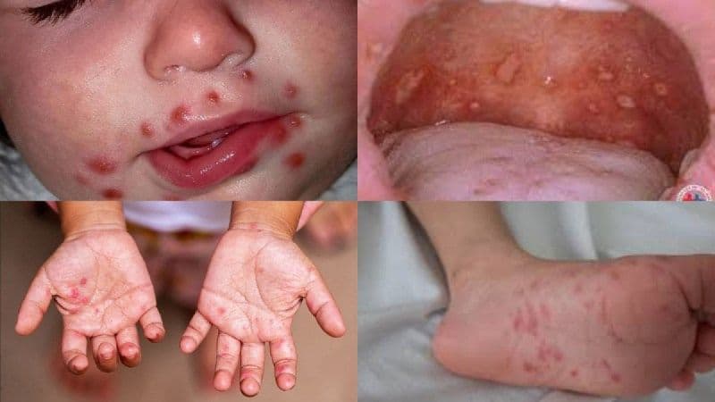 Trẻ sốt, loét miệng, nổi mụn nước ở tay và chân cần được thăm khám để xác định tình trạng bệnh.