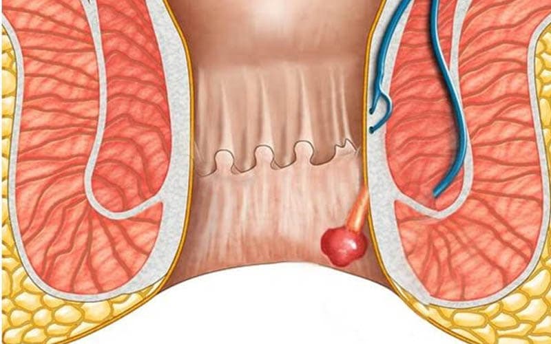 Polyp hậu môn thường có dạng tròn