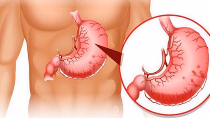 Ở giai đoạn sớm dấu hiệu u dưới niêm mạc dạ dày thường không rõ ràng