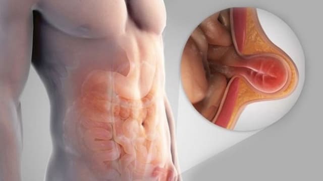 Thoát vị bẹn hai bên: Dấu hiệu nhận biết và phương pháp điều trị