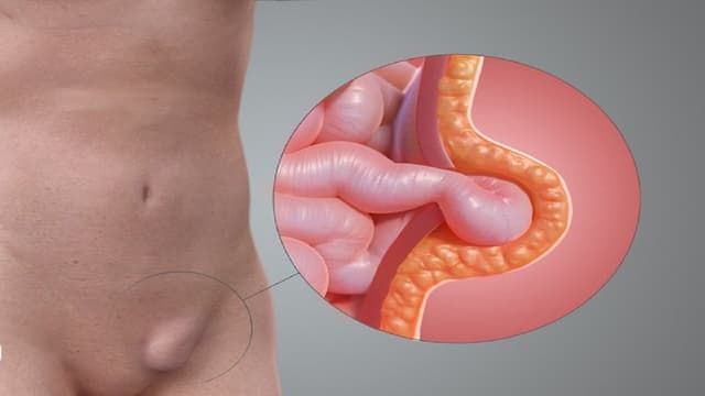 Thoát vị bẹn tái phát là gì? Nhận biết, chẩn đoán và điều trị như thế nào?