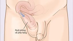 Thoát vị bịt có dấu hiệu gì? Nguyên nhân do đâu điều trị như thế nào?