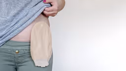 Thoát vị cạnh hậu môn nhân tạo: Dấu hiệu, nguyên nhân và cách điều trị