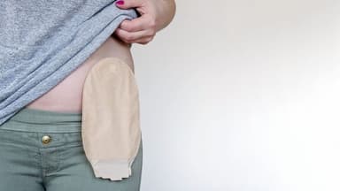 Thoát vị cạnh hậu môn nhân tạo: Dấu hiệu, nguyên nhân và cách điều trị