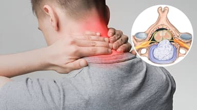 Dấu hiệu thoát vị đĩa đệm cổ cần phải khám sớm