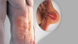 Thoát vị đường trắng là gì? Dấu hiệu nhận biết và cách điều trị