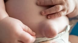 Thoát vị rốn là gì? Cách nhận biết và điều trị như thế nào?