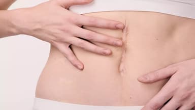 Thoát vị vết mổ là gì? Nhận biết dấu hiệu và điều trị như thế nào?