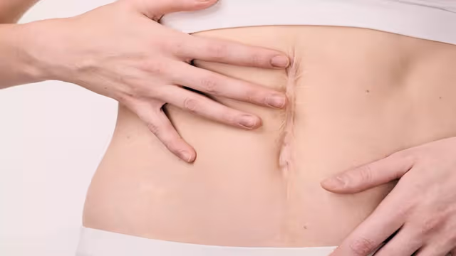 Thoát vị vết mổ là gì? Nhận biết dấu hiệu và điều trị như thế nào?