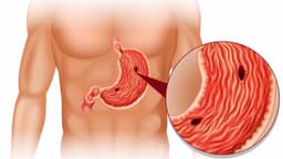 Các triệu chứng thủng dạ dày mà bạn cần lưu ý là gì?