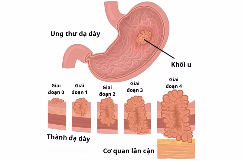 Ở giai đoạn này, khối u đã xâm lấn qua thành dạ dày hoặc di căn đến các cơ quan khác.