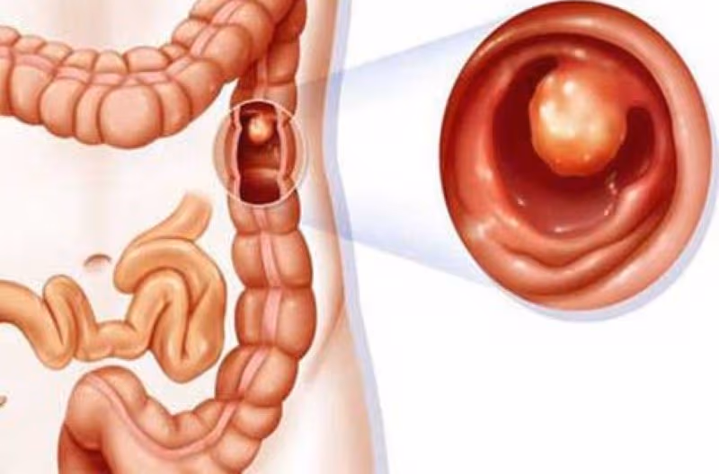 Ở giai đoạn sớm, tổn thương tiền ung thư (như polyp) hoặc khối u kích thước nhỏ thường không gây ra triệu chứng rầm rộ