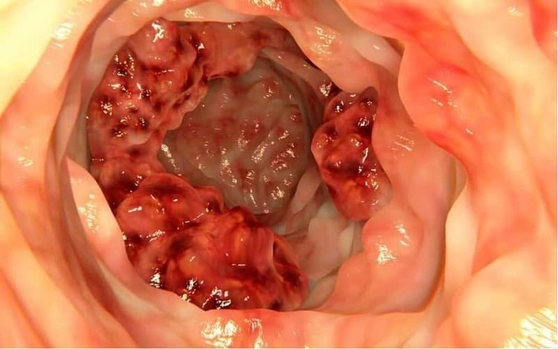 Ung thư hậu môn tiến triển qua 4 giai đoạn, từ khối u khu trú đến khi lan rộng và di căn xa