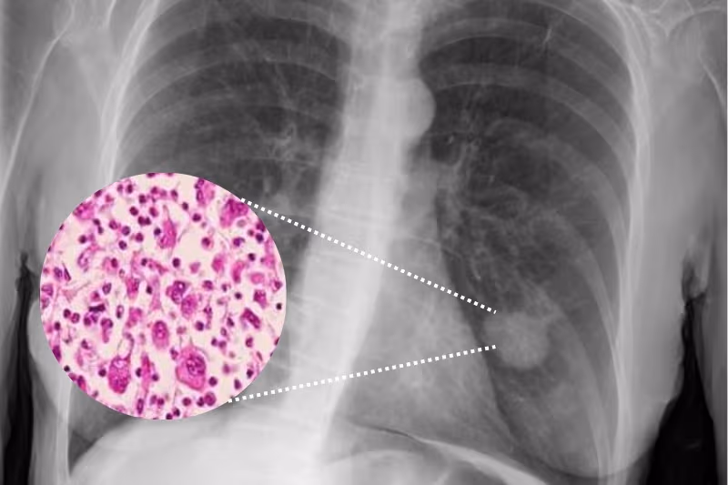 Ung thư phổi không tế bào nhỏ (NSCLC) là nhóm ung thư hình thành từ các tế bào trong mô phổi
