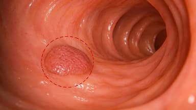 Tổn thương răng cưa không cuống nguy hiểm không? Cần xử trí ra sao?