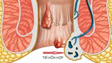 Trĩ hỗn hợp tắc mạch nguy hiểm không? Dấu hiệu và phương pháp điều trị