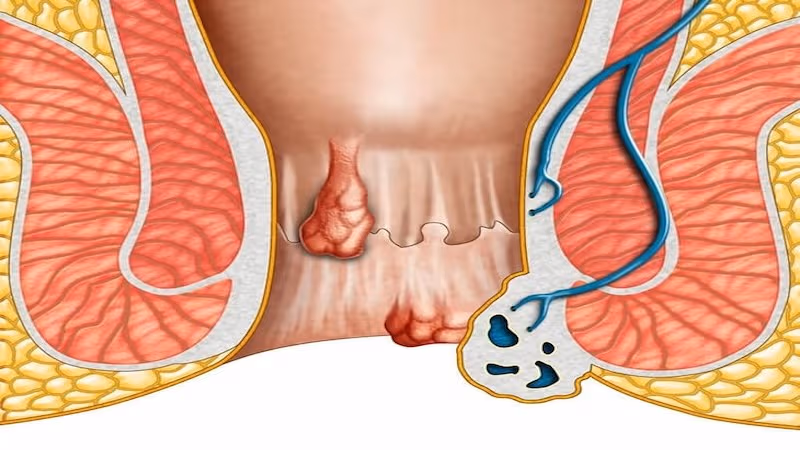 Dấu hiệu trĩ kèm rò hậu môn gồm chảy máu, sa búi trĩ, đau rát và tiết dịch mủ