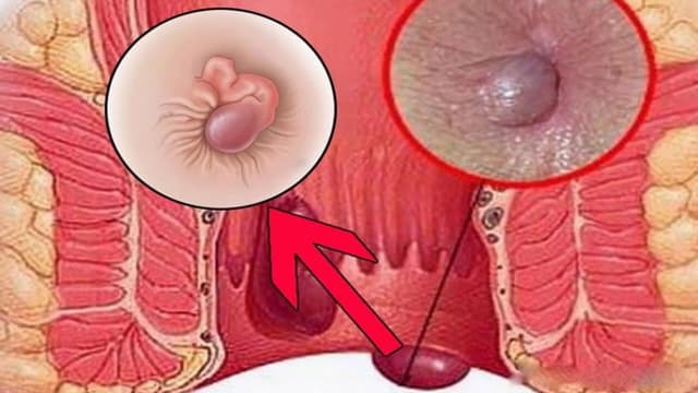 Trĩ kèm rò hậu môn có dấu hiệu gì? Cách điều trị như thế nào?